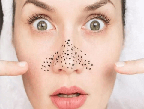 4 Best Blackhead Treatments of 2022：How to Remove Blackheads ?