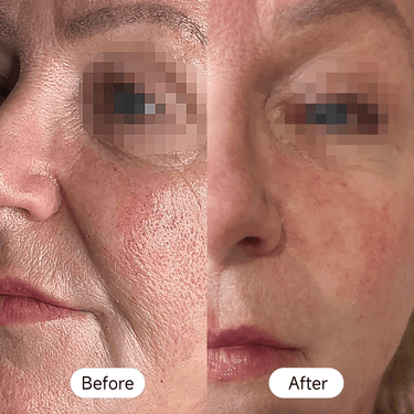 High-quality microdermabrasion machine for deep skin cleansing and rejuvenation